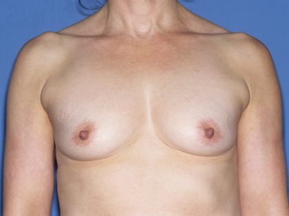 Breast Implants - Breast Augmentation Before & After Patient #2827