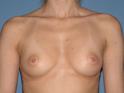 Breast Implants - Breast Augmentation Before & After Patient #2826