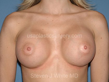 Breast Implants - Breast Augmentation Before & After Patient #2826