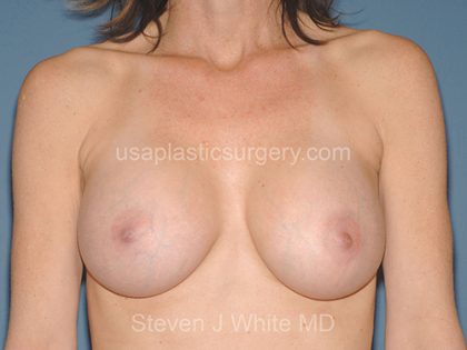Breast Implants - Breast Augmentation Before & After Patient #2825