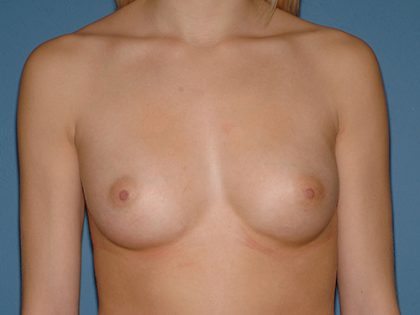 Breast Implants - Breast Augmentation Before & After Patient #2824