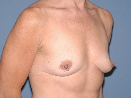 Breast Implants - Breast Augmentation Before & After Patient #1942