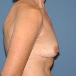 Breast Implants - Breast Augmentation Before & After Patient #1942