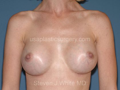 Breast Implants - Breast Augmentation Before & After Patient #2832