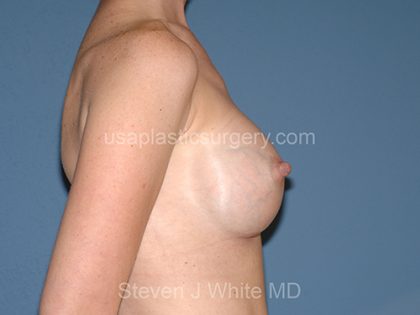Breast Implants - Breast Augmentation Before & After Patient #2832