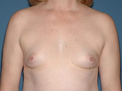 Breast Implants - Breast Augmentation Before & After Patient #2768