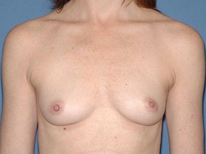 Breast Implants - Breast Augmentation Before & After Patient #2767