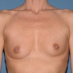Breast Implants - Breast Augmentation Before & After Patient #2765