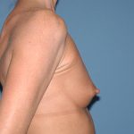 Breast Implants - Breast Augmentation Before & After Patient #2765