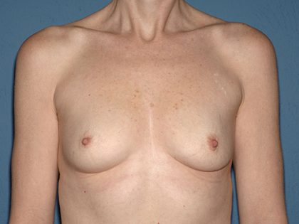 Breast Implants - Breast Augmentation Before & After Patient #2764
