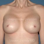 Breast Implants - Breast Augmentation Before & After Patient #2764
