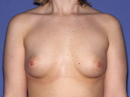 Breast Implants - Breast Augmentation Before & After Patient #1943