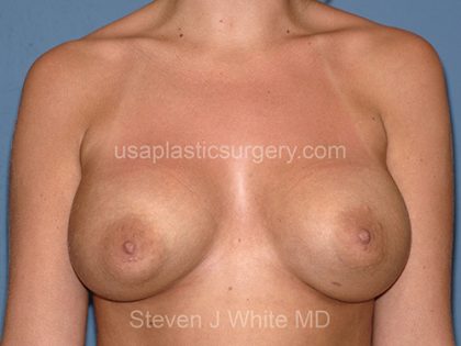 Breast Implants - Breast Augmentation Before & After Patient #2725