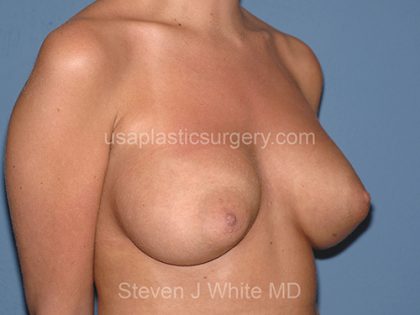 Breast Implants - Breast Augmentation Before & After Patient #2725
