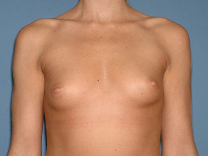 Breast Implants - Breast Augmentation Before & After Patient #2729