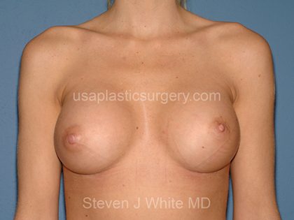 Breast Implants - Breast Augmentation Before & After Patient #2729