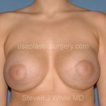 Breast Implants - Breast Augmentation Before & After Patient #2728