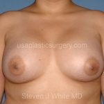 Breast Implants - Breast Augmentation Before & After Patient #2727