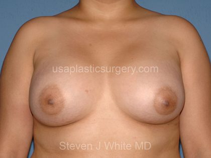 Breast Implants - Breast Augmentation Before & After Patient #2727