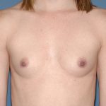 Breast Implants - Breast Augmentation Before & After Patient #2726