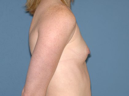 Breast Implants - Breast Augmentation Before & After Patient #2726