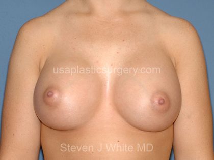 Breast Implants - Breast Augmentation Before & After Patient #2711