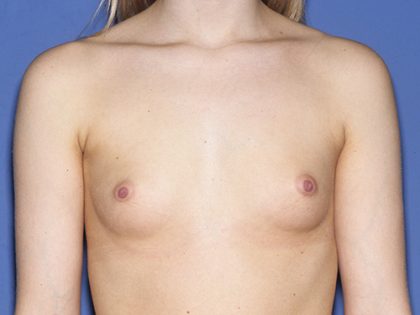Breast Implants - Breast Augmentation Before & After Patient #2704