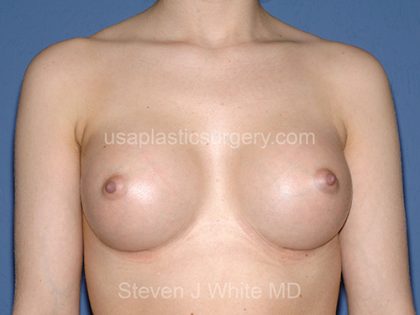 Breast Implants - Breast Augmentation Before & After Patient #2704