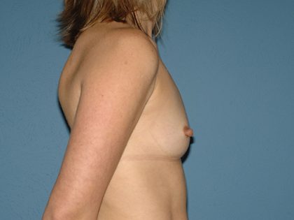 Breast Implants - Breast Augmentation Before & After Patient #1944