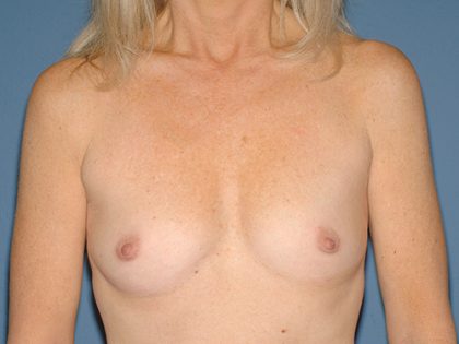 Breast Implants - Breast Augmentation Before & After Patient #2690