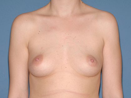 Breast Implants - Breast Augmentation Before & After Patient #1947