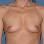 Breast Implants - Breast Augmentation Before & After Patient #1948