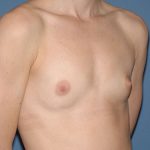 Breast Implants - Breast Augmentation Before & After Patient #1949