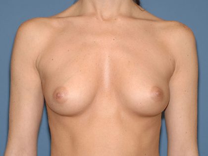 Breast Implants - Breast Augmentation Before & After Patient #2014