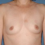 Breast Implants - Breast Augmentation Before & After Patient #2016
