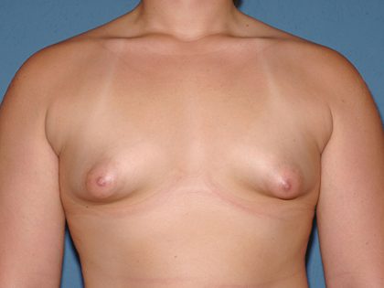 Breast Implants - Breast Augmentation Before & After Patient #2017