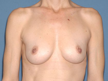 Breast Implants - Breast Augmentation Before & After Patient #2020