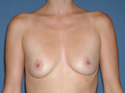 Breast Implants - Breast Augmentation Before & After Patient #2021