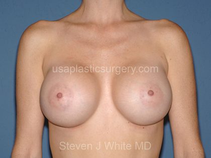 Breast Implants - Breast Augmentation Before & After Patient #2021