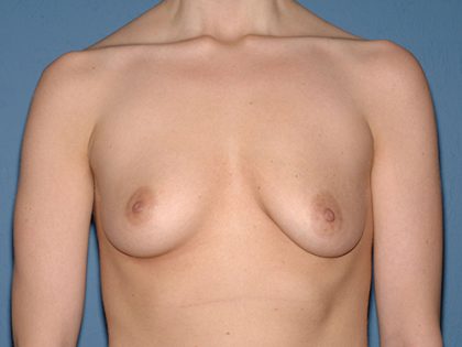 Breast Implants - Breast Augmentation Before & After Patient #2022