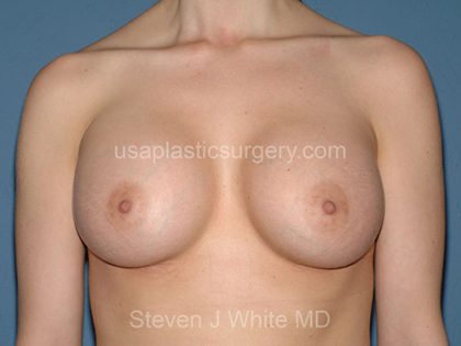 Breast Implants - Breast Augmentation Before & After Patient #2022