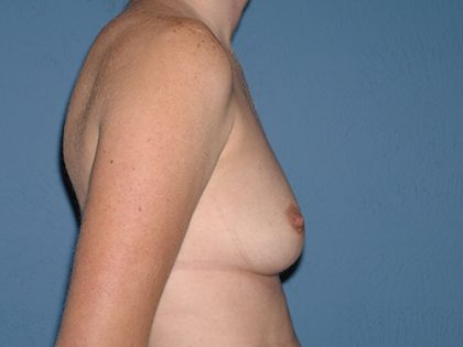 Breast Implants - Breast Augmentation Before & After Patient #1880