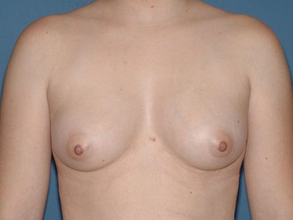 Breast Implants - Breast Augmentation Before & After Patient #2109