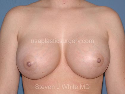 Breast Implants - Breast Augmentation Before & After Patient #2109