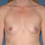 Breast Implants - Breast Augmentation Before & After Patient #2111