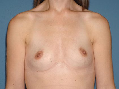 Breast Implants - Breast Augmentation Before & After Patient #2112