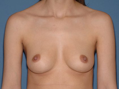 Breast Implants - Breast Augmentation Before & After Patient #2113
