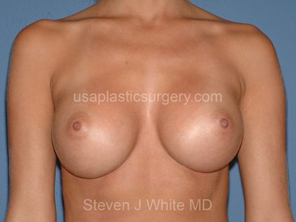 Breast Implants - Breast Augmentation Before & After Patient #2114