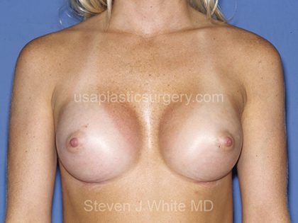 Breast Implants - Breast Augmentation Before & After Patient #2115