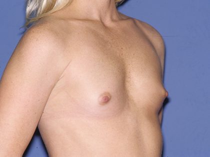 Breast Implants - Breast Augmentation Before & After Patient #2115